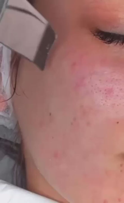 LIMPIADOR FACIAL ULTRASONICO